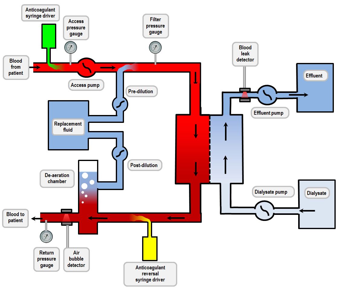CVVHDF circuit diagram Deranged Physiology